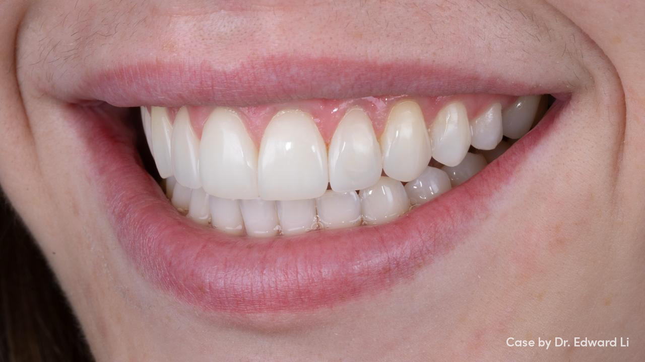 Teeth after Boutique whitening
