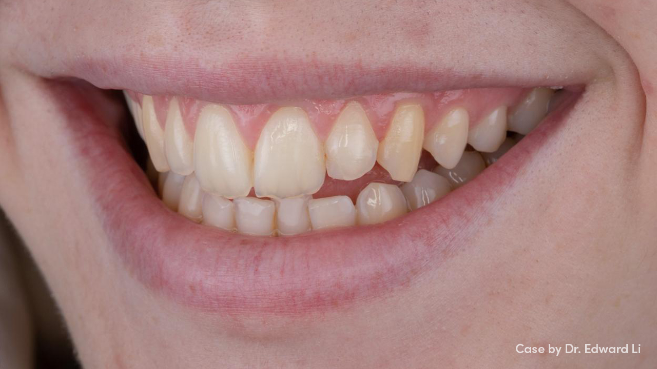 Teeth before Boutique whitening